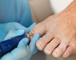 What Is the Fastest Way to Cure Nail Fungus?