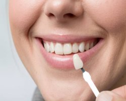  Step-by-Step Healing and Adjustment Timeline After Treatment Dental Veneers in Islamabad Pakistan: