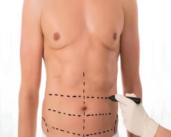 The Ultimate Guide to Liposuction in Islamabad