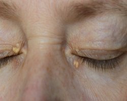 What Are the Most Effective Eyelid Xanthelasma Removal Techniques?