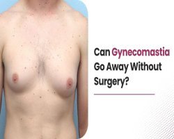 Can Gynecomastia Go Away Without Surgery?