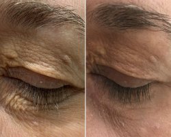 Clinics Worth Considering for Eyelid Xanthelasma Removal
