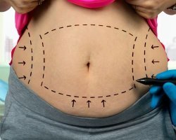 How much fat can be removed during liposuction?