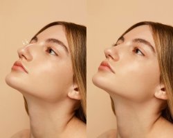 7 Realities of Rhinoplasty Before and After Transformation