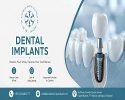 Everything About the Best Dental Implants in Islamabad