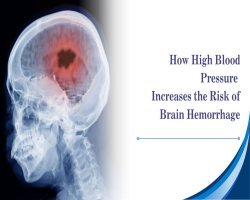 How High Blood Pressure Increases the Risk of Brain Hemorrhage