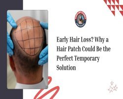 Early Hair Loss? Why a Hair Patch Could Be the Perfect Temporary Solution