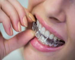 Custom Dentures and Night Guards: Convenient Options for a Healthier, More Confident Smile