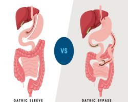 Sleeve Gastrectomy vs Gastric Bypass: Making Sense of Your Weight-Loss Surgery Options