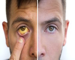 Why the Skin Turns Yellow: A Clear Guide to Jaundice in Adults